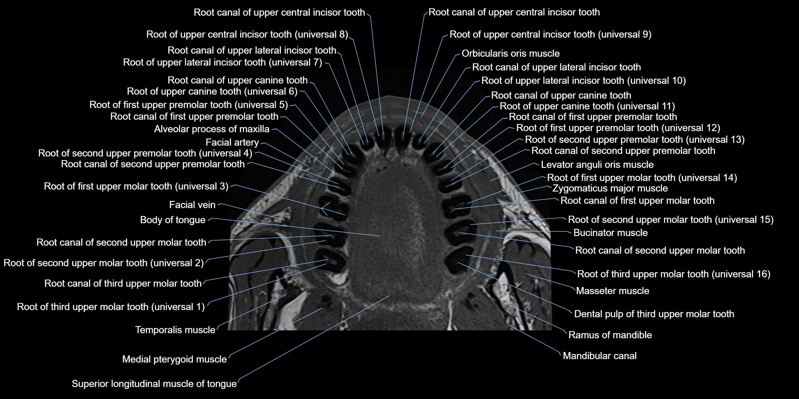 Dental MRI( tooth) axial labelled  cross sectional 3T anatomy -img-00005.webp